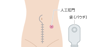 図：直腸切断術