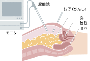 図：腹腔鏡下手術